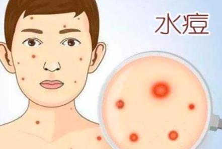 水痘进入高发期 专家提醒,水痘高发期是什么年龄