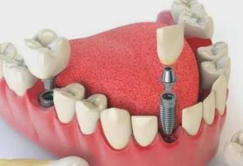 2023年种牙可以走医保吗,2023年种牙医保能报销吗