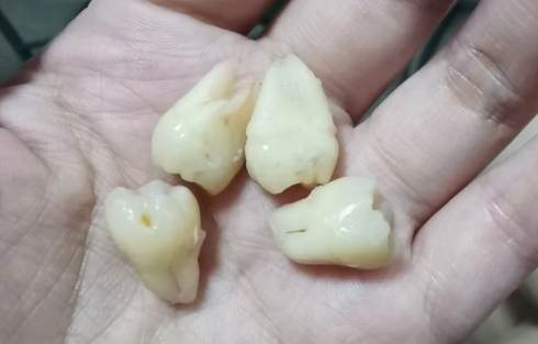 为什么有的牙齿有2个牙根有的没有,有两个牙根的是什么牙