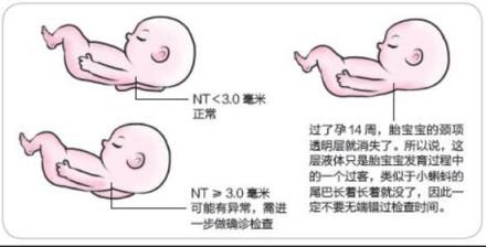NT检查不通过孩子很危险,孕期的nt可以检查的准确率是多少